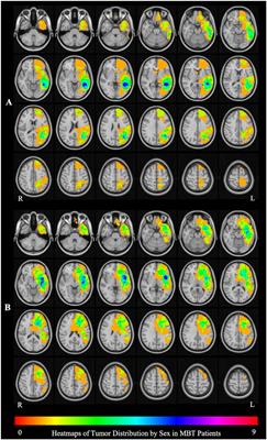 Sex Effect on Presurgical Language Mapping in Patients With a Brain Tumor